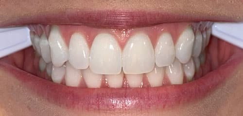 Teeth WingHaven Orthodontics in O'Fallon, MO